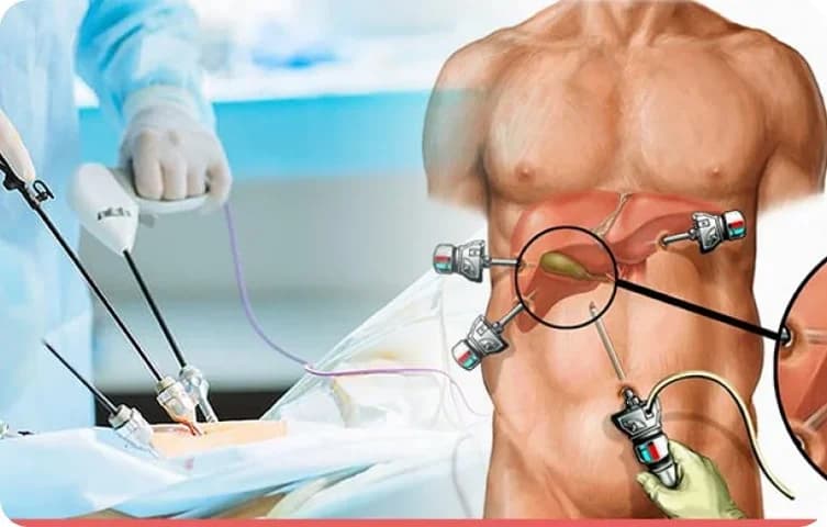 Cirurgia de Vesícula: o que é, quando é indicada e como é a recuperação